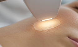 Lazer Peeling Nedir ve Cildiniz İçin Faydaları Nelerdir ?